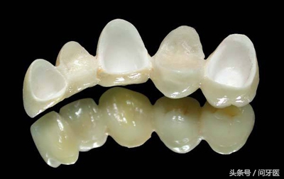 美容冠修复龅牙的利弊,美容冠矫正牙齿怎么样