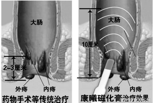 十人九痔久治不愈,十人九痔痔疮久拖不治危害大