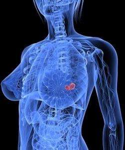 乳腺癌luminala型2期治愈率,乳腺癌luminala型用什么治疗方法