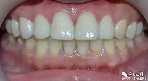门牙旁边有缝最好的解决方法,门牙缝漏怎么补救