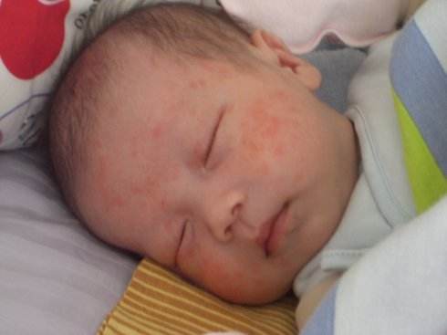 婴儿湿疹的常见原因及防治7绝招,宝妈湿疹都用的什么药膏