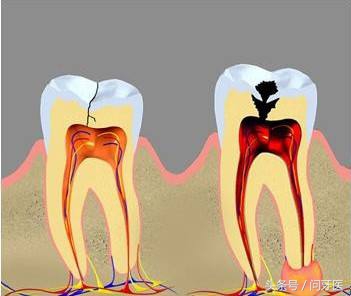 杀了牙神经牙齿咬合还是有感觉,牙神经抽掉今后对牙齿有影响吗