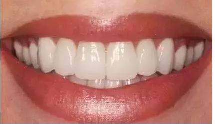 怎么知道牙齿贴面材料真假,牙齿缝隙大适合做贴面还是牙冠