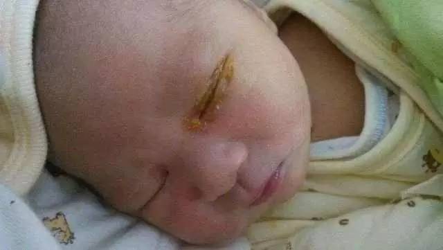 幼儿园小朋友结膜炎怎么办,幼儿园结膜炎视频