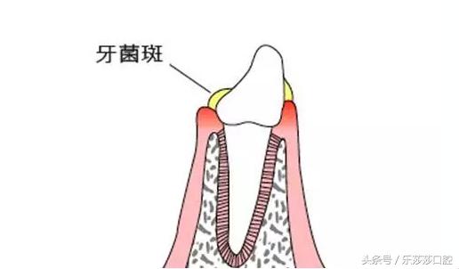 牙齿掉出一小块石头,牙齿内侧掉出一块石头怎么回事