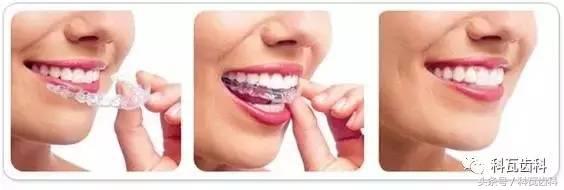 门牙旁边有缝最好的解决方法,门牙缝漏怎么补救