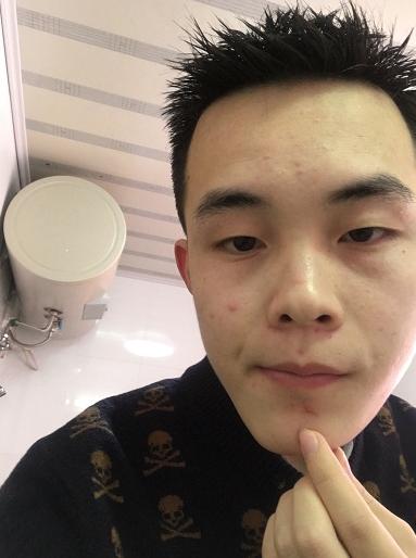 熬夜通宵加班脸上长痘,熬夜加班受不了了