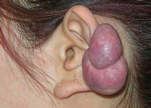 word妈呀！你真的不重视疤痕疙瘩治疗吗？看看这些危害吧