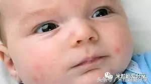 婴儿湿性湿疹快速消退方法,湿疹是因为皮肤差吗