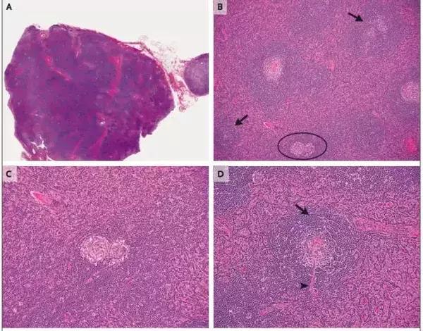 男性右下腹部囊性包块,男性右侧盆腔囊性包块