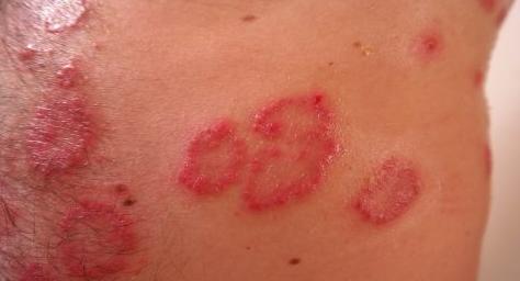 湿疹影响宝宝的皮肤小儿湿疹治疗方法