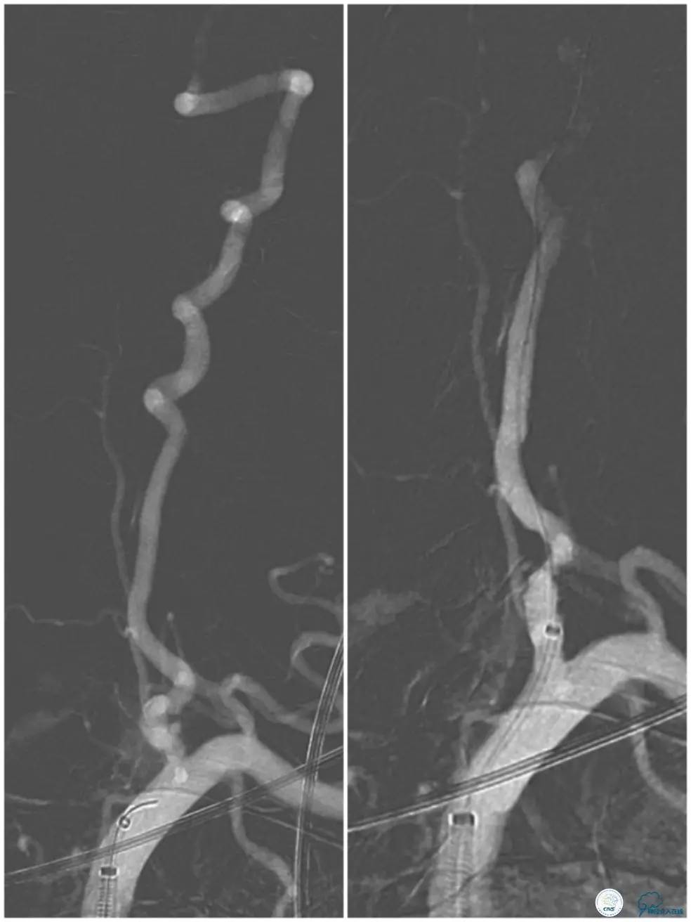 天坛椎动脉狭窄,天坛周记