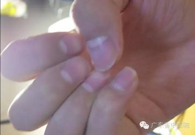 月牙是否真的能说明健康状况,月牙痕跟健康有关系吗