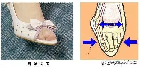 大脚趾甲有点轻微的嵌甲怎么处理,嵌甲手术后指甲还能恢复原样吗