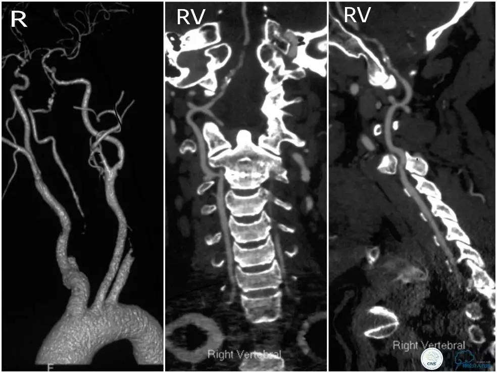 天坛周记｜右椎动脉V1段及V4-基底动脉串联病变支架治疗一例