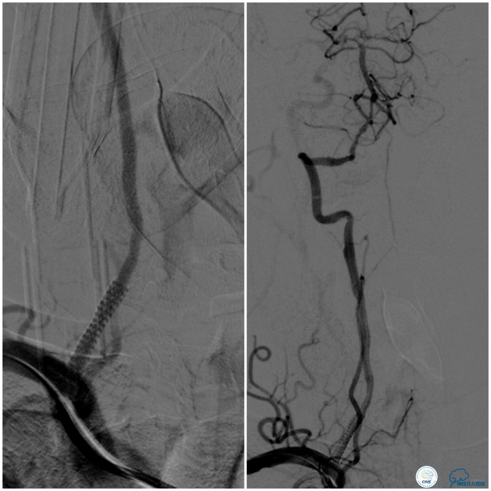 天坛周记｜右椎动脉V1段及V4-基底动脉串联病变支架治疗一例