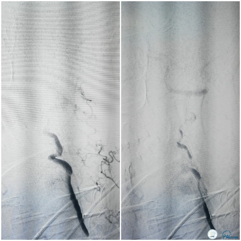 天坛椎动脉狭窄,天坛周记