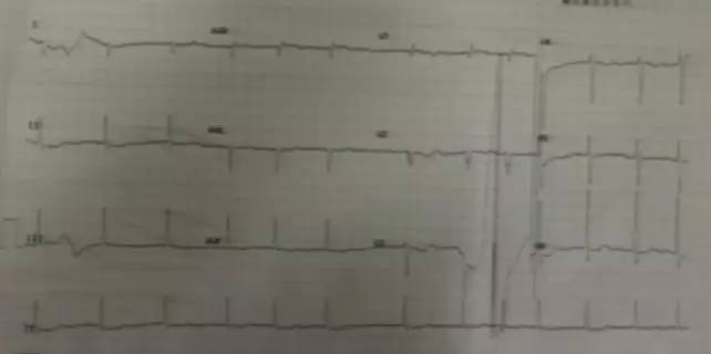 心脏增大引发的心衰能治好吗,急性心衰引起心脏扩大能治愈吗