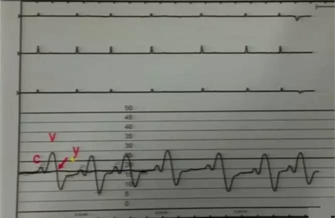 心脏增大引发的心衰能治好吗,急性心衰引起心脏扩大能治愈吗