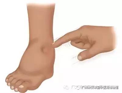 中药专治下肢浮肿效果好,中药治疗面部浮肿