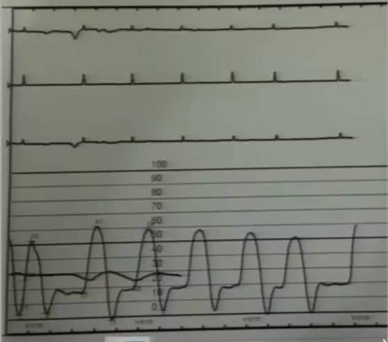 心脏增大引发的心衰能治好吗,急性心衰引起心脏扩大能治愈吗