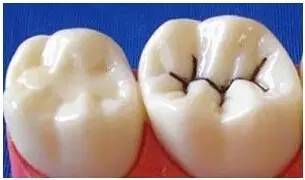 医生说龋齿太浅不用补,医生有蛀牙