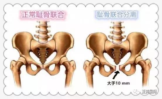 耻骨联合分离，那些莫名其妙的痛，你知多少？