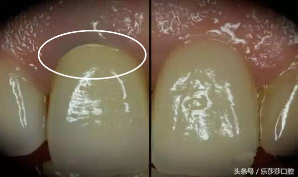 烤瓷牙牙基烂没了怎么办,烤瓷牙会变形状吗