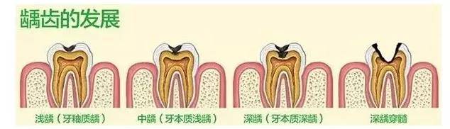 医生说龋齿太浅不用补,医生有蛀牙