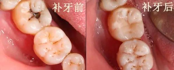 医生说龋齿太浅不用补,医生有蛀牙
