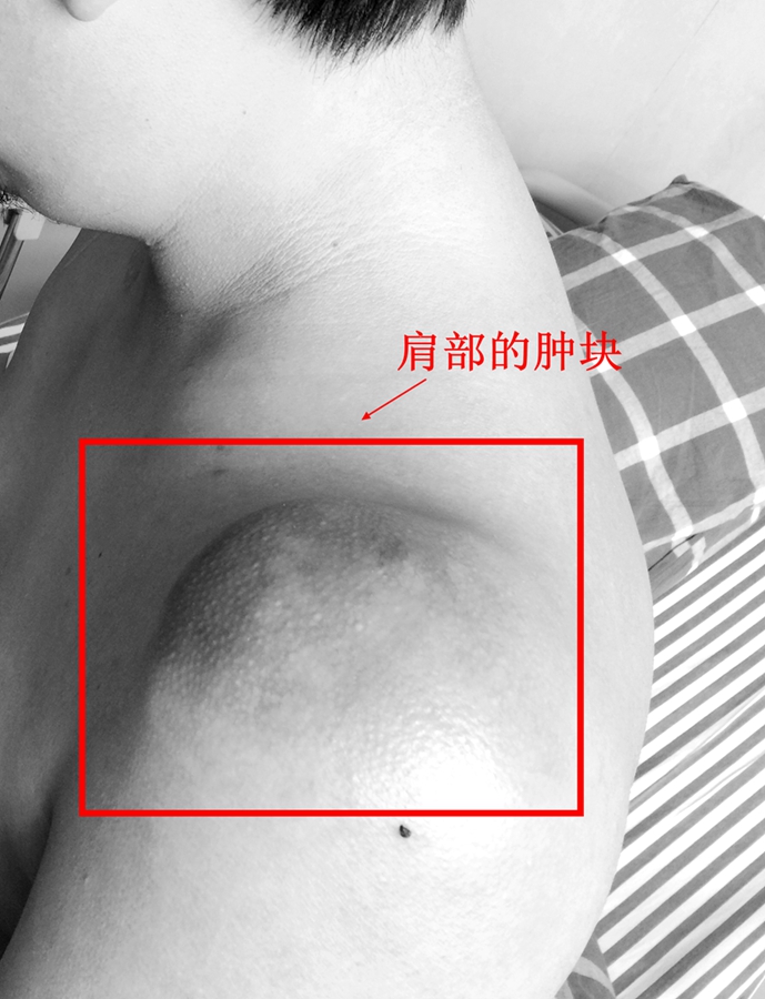 男子患肉瘤,滑膜肉瘤良性切除