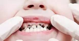 医生说龋齿太浅不用补,医生有蛀牙