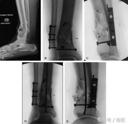 胫骨远端骨折怎样促进愈合,胫骨外侧骨折怎么处理