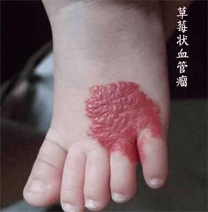 海绵状血管瘤治疗费用大概多少钱,怎么能快速消除血管瘤