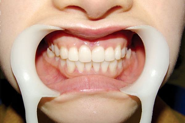 牙痛不用吃西药，用这种最常见的食疗方法治疗，简单有效！