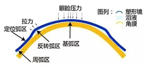 角膜塑形镜真假,央视曝光的角膜塑形镜
