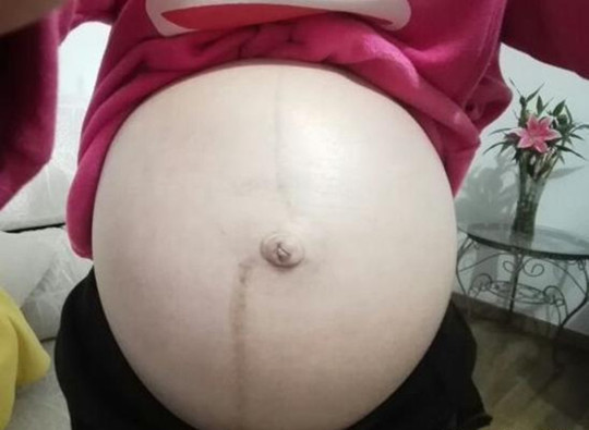 怀孕看肚子上的线准吗偏左偏右,怎么看妊娠线偏左还是偏右图片