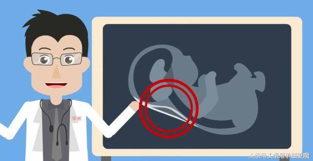 nt检查11周去还是12周去比较好,孕12-16周做nt检查需要关注什么