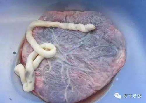 胎盘长什么样,胎盘植入你了解吗