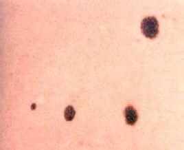切除黑毛痣有什么危害,黑毛痣对身体的危害