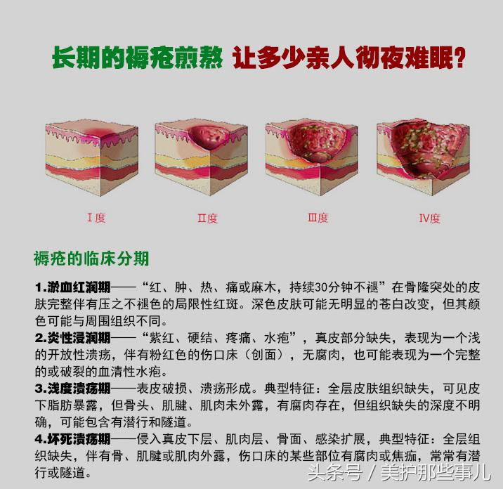 褥疮用酒精敷伤口行吗,用酒精消毒能治褥疮吗