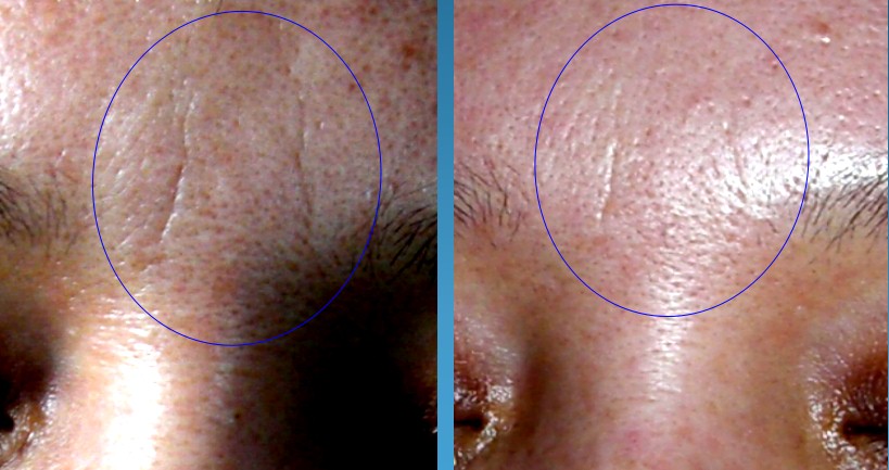 皮肤敏感泛红怎么选择光子嫩肤,油性皮肤怎么推荐光子嫩肤