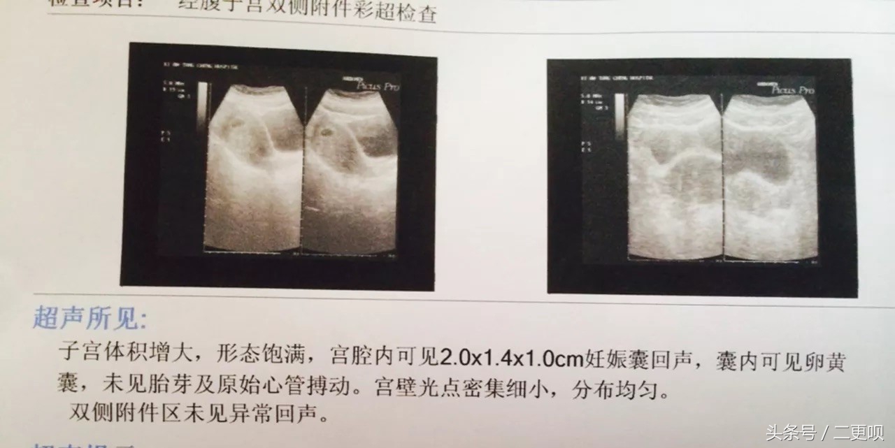 怀孕7周看得出来双胞胎吗,孕7周双胞胎bc超图是怎样的