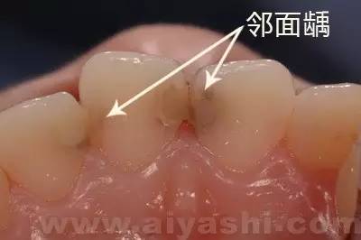 医生说龋齿太浅不用补,医生有蛀牙