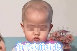 佝偻病各个阶段的症状,佝偻病初期的主要症状