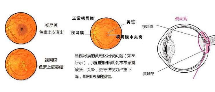 同仁医院刘武看黄斑病变怎么样,同仁医院眼底黄斑病变图