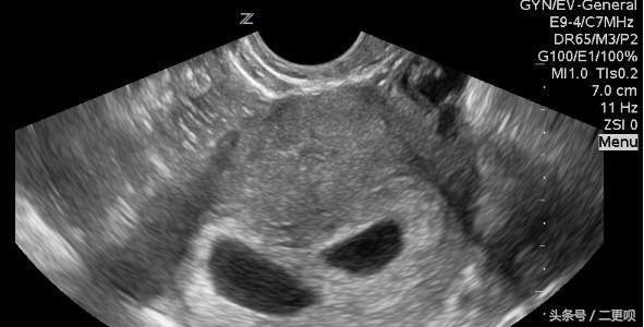 怀孕7周看得出来双胞胎吗,孕7周双胞胎bc超图是怎样的