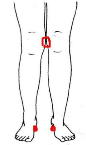 腿型不直如何矫正,老年人长时间大腿弯曲该怎样矫正