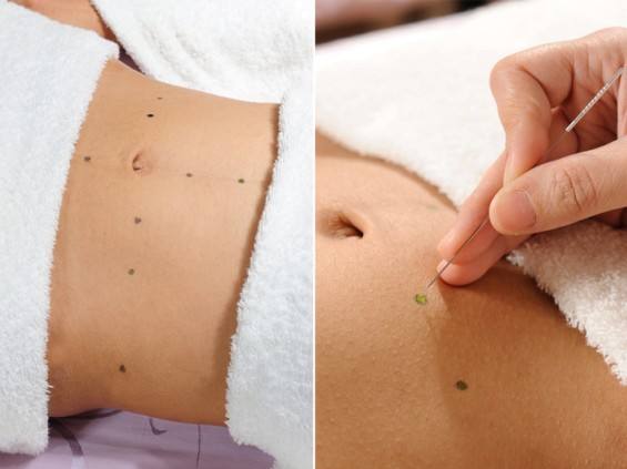 埋线减肥后怎样才能不反弹,埋线减肥肚子反而更大了