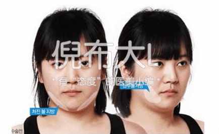 打完瘦脸针后如何维持瘦脸效果,打了瘦脸针脸上的肉会变多吗